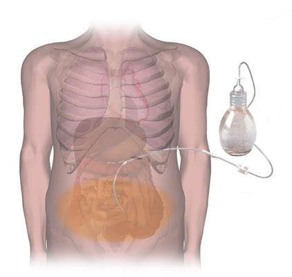 Pleurex Catheter Insertion — Minimally Invasive Procedures Victoria