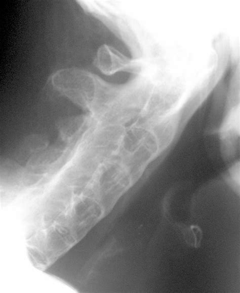 Ankylosing spondylitis x ray - wikidoc