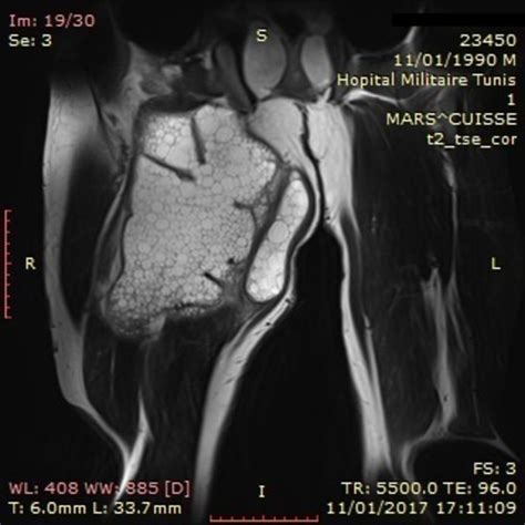 Hydatid cyst of the thigh: a challenging diagnosis | BMJ Case Reports