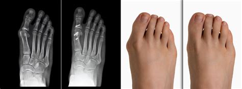 Hallux Valgus | Causes, douleurs, traitement et chirurgie | CPHG Paris