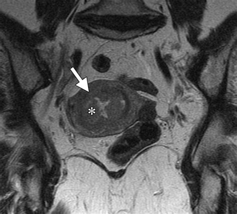 FIGO Staging System for Endometrial Cancer: Added Benefits of MR ...