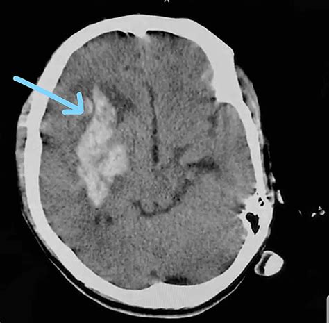 Cureus | Takotsubo Cardiomyopathy in a Case of Intracerebral Hemorrhage: A Case Report