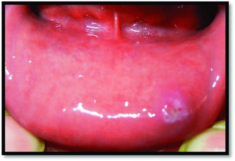 Mucosal irritation and ulceration due to movement of jig. | Download Scientific Diagram