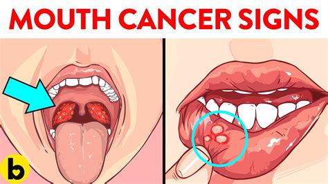 Pictures Of Early Signs Of Tongue Cancer - Infoupdate.org