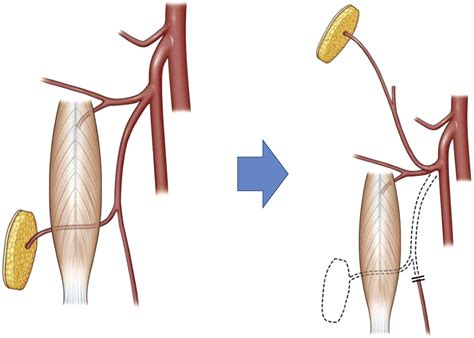 Rotation arc of pedicled anterolateral thigh flap for abdominal wall reconstruction: How far can ...