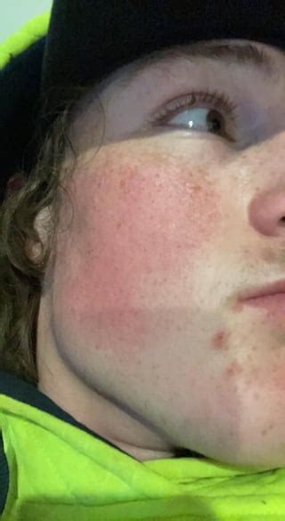 Metronidazole gel. Before/1 week after use/3 weeks after use.improvement : r/Rosacea