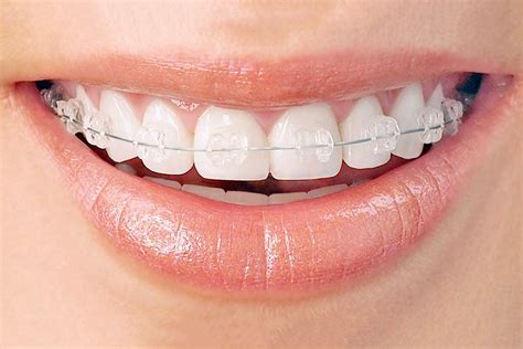 What are Ceramic Invisible Braces | Clear Braces Orthodontics Sydney