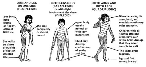 Cerebral Palsy Introduction - Physiopedia