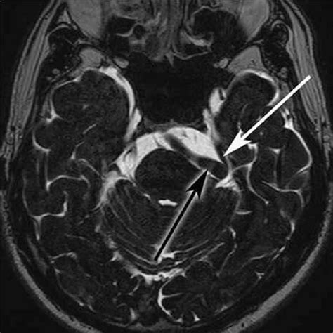 Basilar artery and left trigeminal nerve in the axial plane on magnetic ...