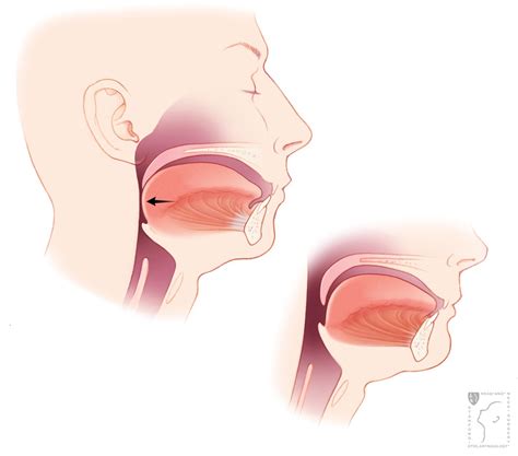 Obstructive Sleep Apnea Diagnosis | Stanford Health Care