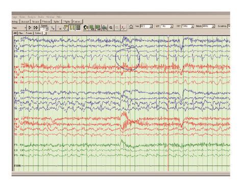 Bipolar EEG montage showing left occipital sharp waves (P3, O1 ...