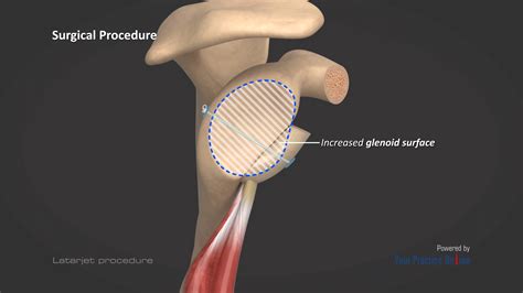 Latarjet Procedure Video | Medical Video Library