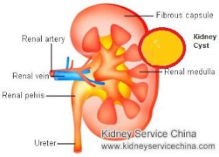 treatment for kidney disease: Cortical Kidney Cysts Can Be Treated