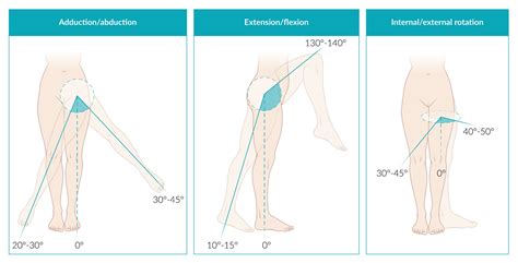 Hyperextension Of Hip