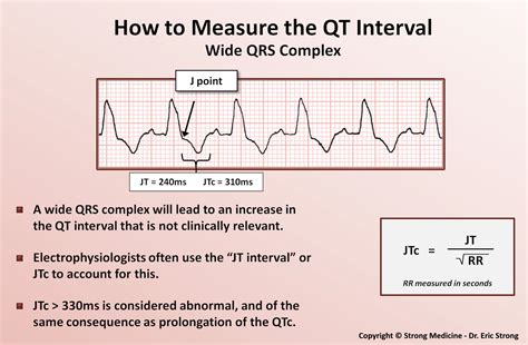 Ecg Pr Interval Normal Range In Ms - Printable Templates Protal