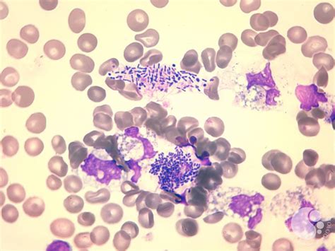 Free and intracellular bacteria on peripheral blood smear