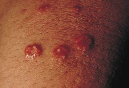 Multiple Umbilicated Papules on a Young Man | Dermatology | JAMA ...