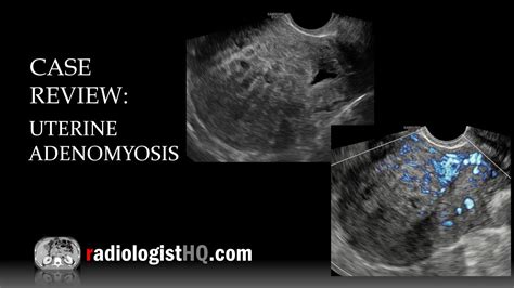 Case Review: Ultrasound of Uterine Adenomyosis - YouTube