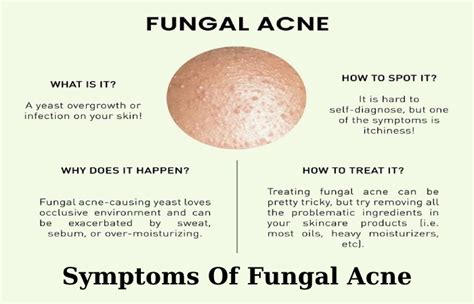 Fungal Acne - Causes, Symptoms, Diagnosis, How To Treat And Prevent?