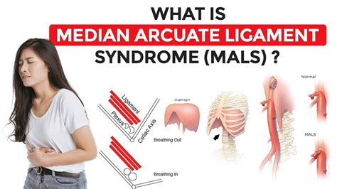 Median Arcuate Ligament Syndrome in Hindi, MALS | Symptoms, Reasons, Cost, Pain Treatment in ...