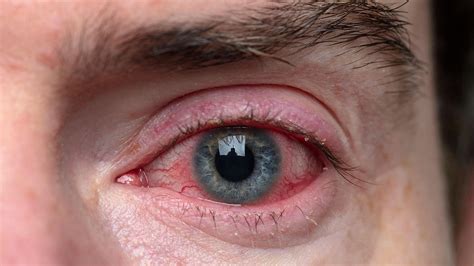 Psoriatic Arthritis and Eye Problems: What You Need to Know