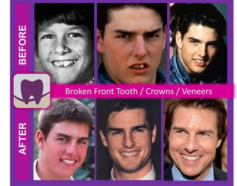 Celebrity Smiles Revealed: Tom Cruise – Stouffville Smiles Dentistry