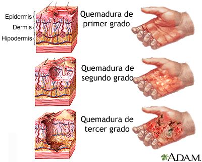 Enfermer@ en Urgencias y UCI : Quemaduras