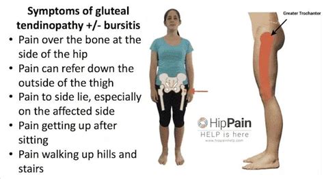 Gluteal Tendinopathy Symptoms + Diagnosis (GTPS)+/- Trochanteric ...