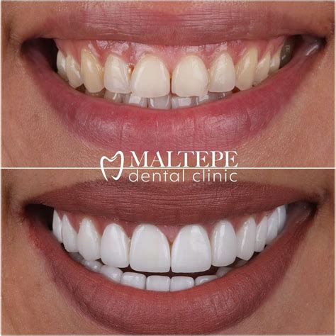 Tout ce que vous avez toujours voulu savoir sur Hollywood Smile - Maltepe Dental Clinic