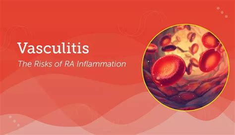 Vasculitis: The Risks of RA Inflammation | myRAteam