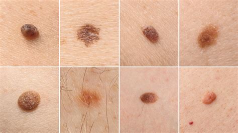 Understanding the different types of moles | Spot Check Clinic