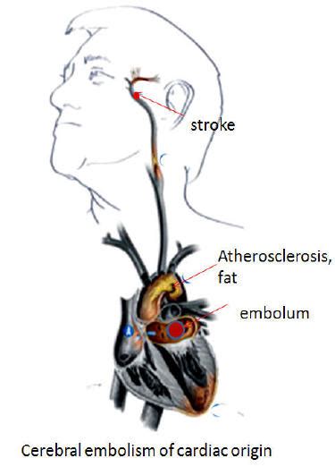 Il paziente vascolare: patologia occlusiva delle arterie cerebrali e l ...