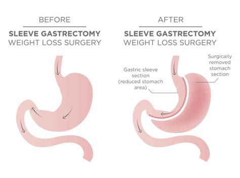 Gastric Sleeve vs Gastric Bypass