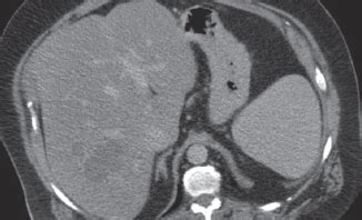 What Is Causing a Pyogenic Liver Abscess in This Immune-Competent Adult ...