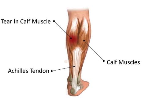 Calf muscle pain cause and treatment with exercises for relief