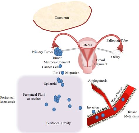 Circulating non-coding RNAs in recurrent and metastatic ovarian cancer