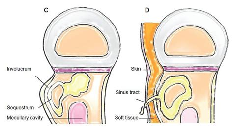 Figure 2 The pathogenesis of hematogenous osteomyelitis. (C) A segment of devitalized cortical ...