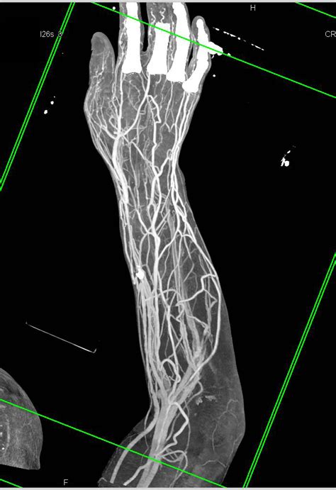 Abscess in Forearm with CTA and 3D - Musculoskeletal Case Studies - CTisus CT Scanning