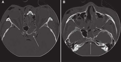 Sphenoid Bone Fracture