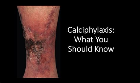 emDOCs.net – Emergency Medicine EducationCalciphylaxis: An Ominous Skin Condition You Should ...