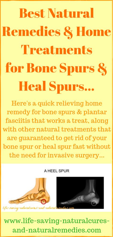 Best natural remedies & home treatments for bone spurs & heal spurs ...