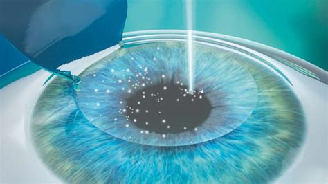 Femto-LASIK – accuratis