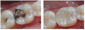 White (Composite) Fillings - Fort York Dentist