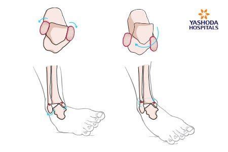 Vertical Talus: What is Vertical Talus, its Causes?