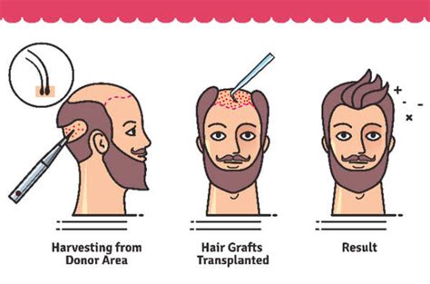 Hair Transplant - Facts, Steps, Surgical Process & Everything you ...