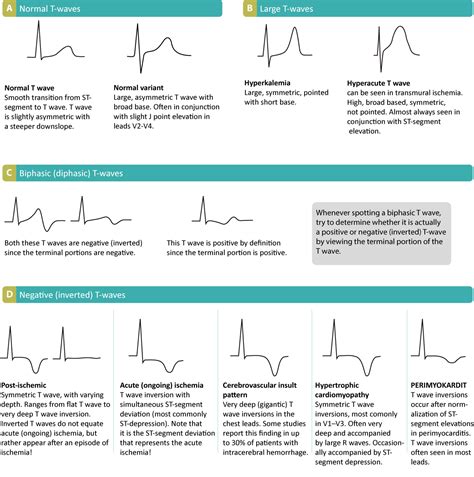 ECG interpretation: Characteristics of the normal ECG (P-wave, QRS complex, ST segment, T-wave ...