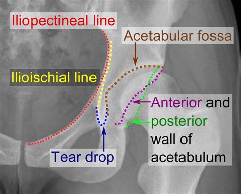 File:Iliopectineal line, ilioischial line, tear drop, acetabular fossa, and anterior and ...