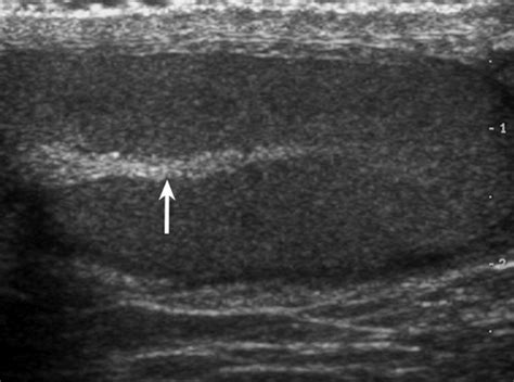 Role of US in Testicular and Scrotal Trauma | RadioGraphics