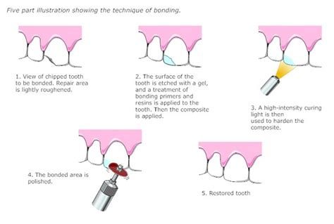 Low cost Dental Tooth Bonding in Riverside