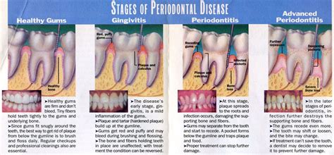 Gums Care, Health Gums, Flossing, Sensitive Gums